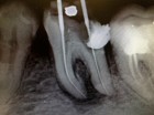 Endodonzia - Studio Dentistico Conconi 