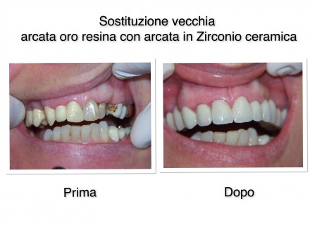 Lavori eseguiti in Ceramica - Studio Dentistico Conconi 