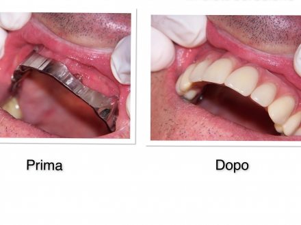 TECNICA IN ELETTROEROSIONE - Studio Dentistico Conconi 